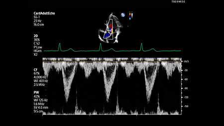 Adult echo LVOT with Pulsed wave and color using S5-1 transducer.
