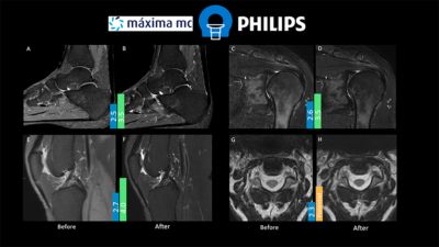 Figure 1.  Images displayed comparing before [A, C, E, G] and after protocol optimization [B, D, F, H]. Scores in blue bar indicate average result before the optimization. Scores in green bar indicate the average IQ result after protocol optimization.