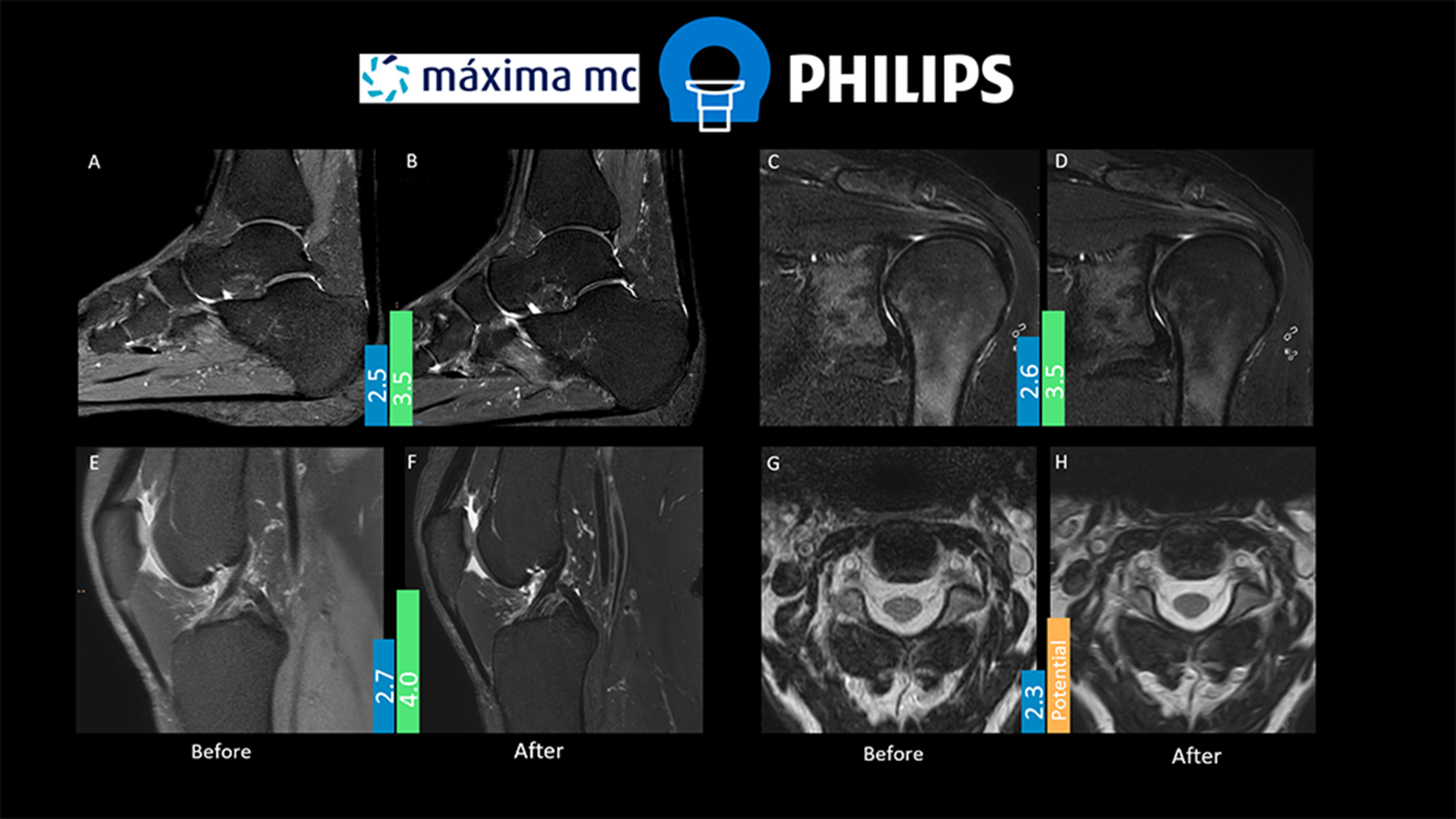 Figure 1.  Images displayed comparing before [A, C, E, G] and after protocol optimization [B, D, F, H]. Scores in blue bar indicate average result before the optimization. Scores in green bar indicate the average IQ result after protocol optimization.