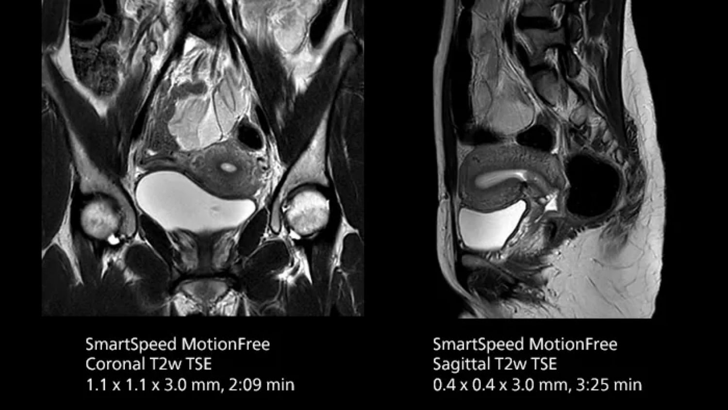 Motion robustness and high-resolution uterus protocol.
