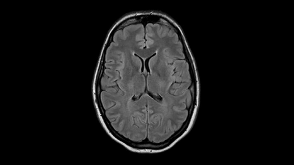 T2w FLAIR clinical image of the brain