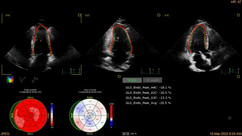 AutoStrain LV showing GLS and results