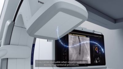 EchoNavigator R4 advanced fusion advances with you