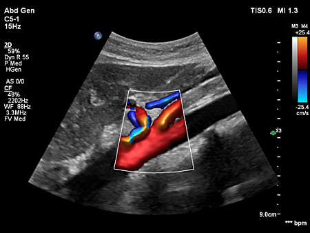 C5-1 Abdominal Proximal Aorta with Flow Viewer