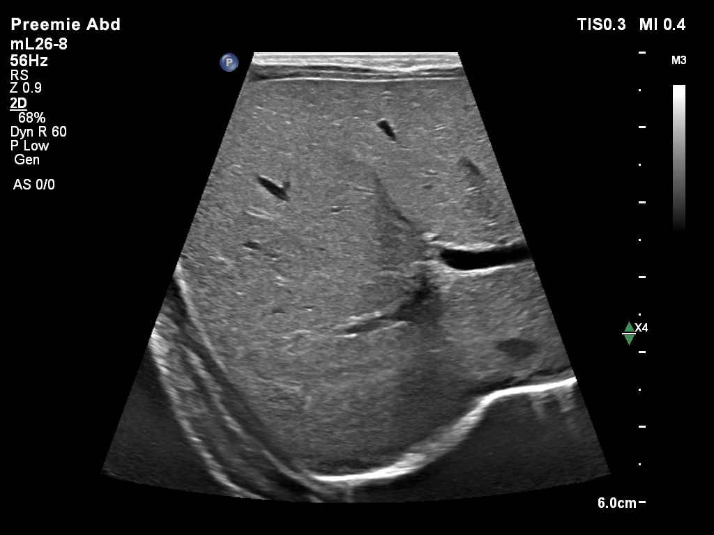 mL26-8 Pediatric Liver
