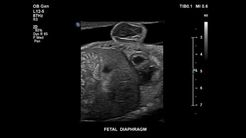 Fetal diaphragm