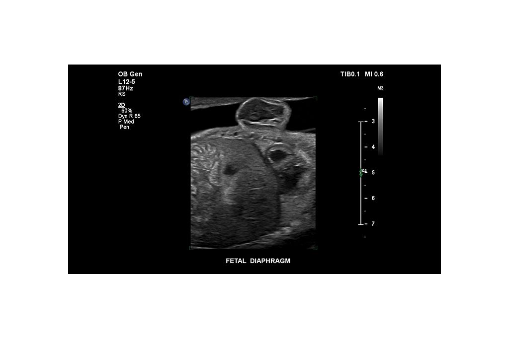 Fetal diaphragm