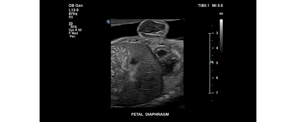 Fetal diaphragm
