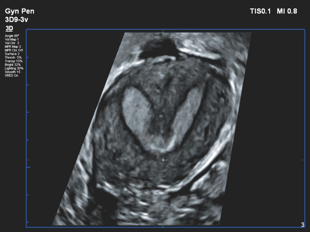 Affiniti 30 ultrasound clinical image gynecology