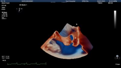 3d echocardiogram hartklep