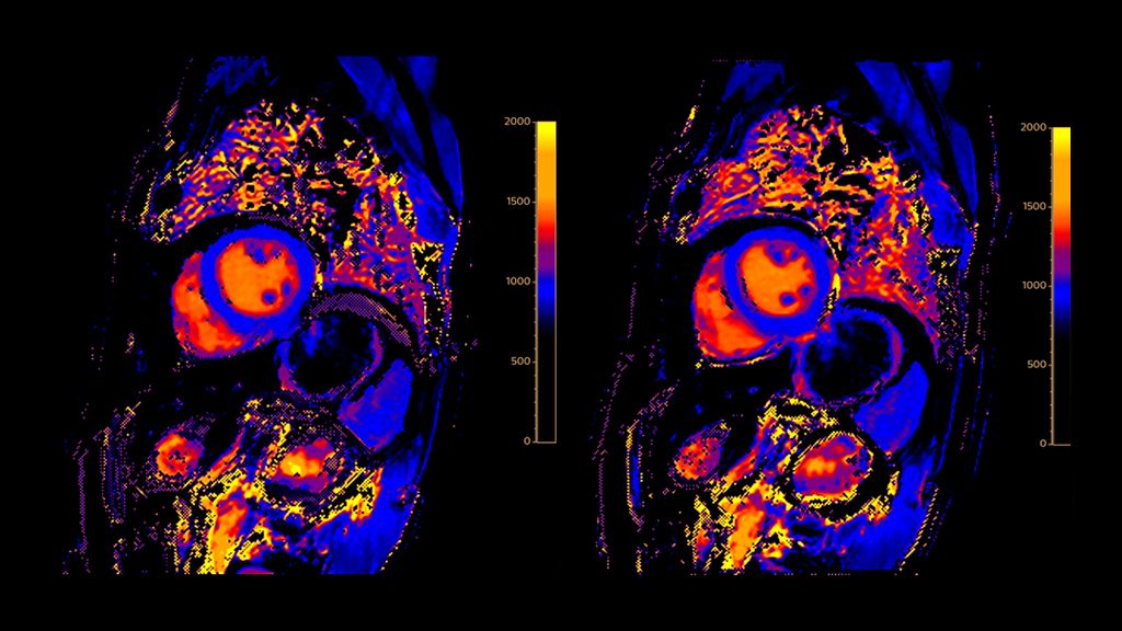 T1 conventional confidence map versus T1 Cardiac Motion Correction confidence map