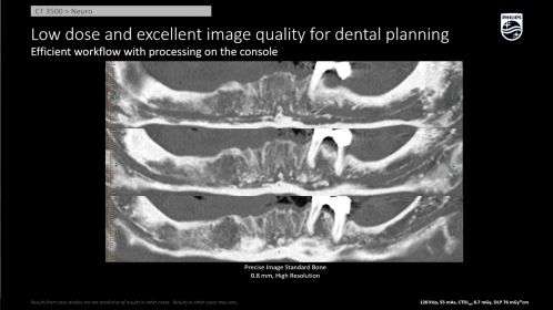 Dental Planning Precise Image AI Recon