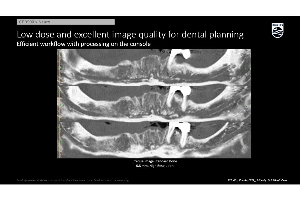 Dental Planning Precise Image AI Recon