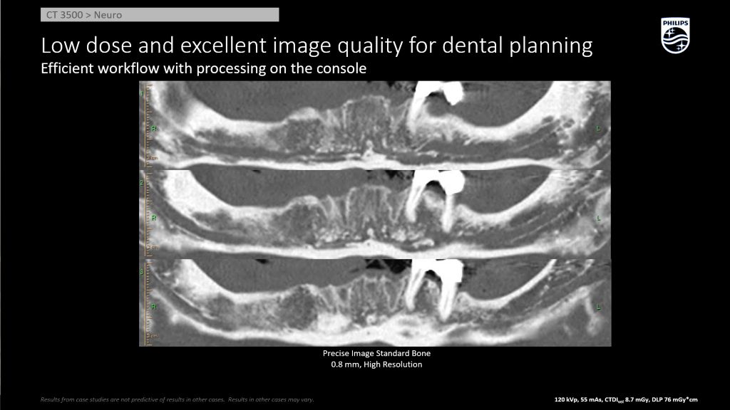Dental Planning Precise Image AI Recon