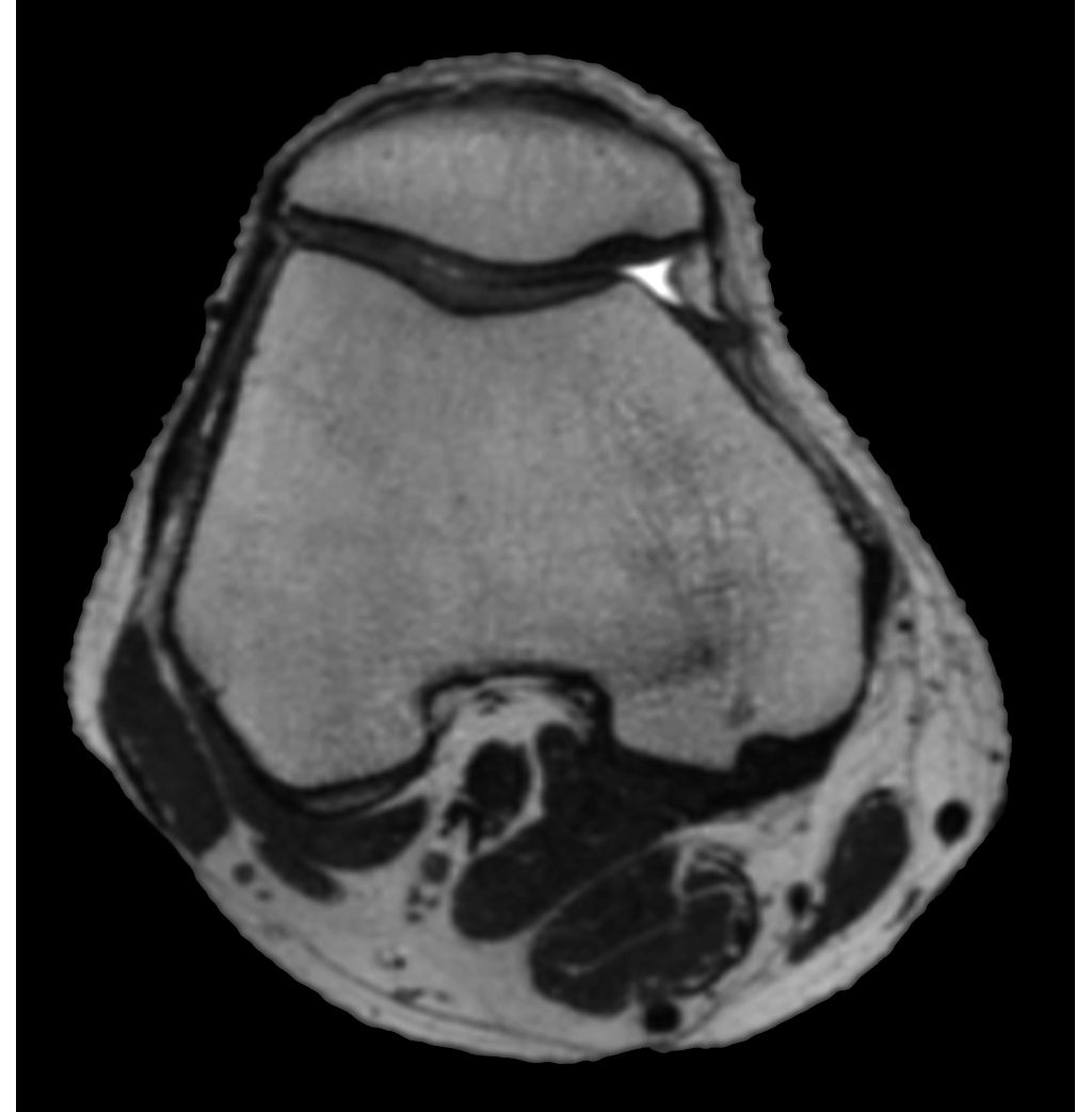 3D MSK VIEW - T2w TSE (axial reformat)