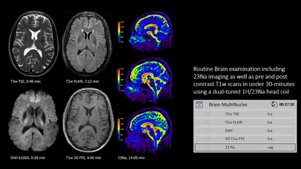 Multi Nuclei Brain exam 1H and 23Na