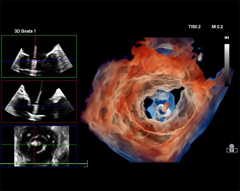 Live 3D TEE clinical image of mitral valve shown using TrueVue Glass feature.