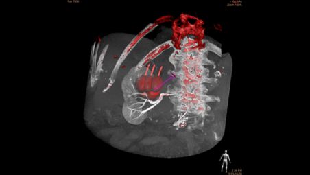 Planning, Guidance and Control in Tumor Ablation Procedures