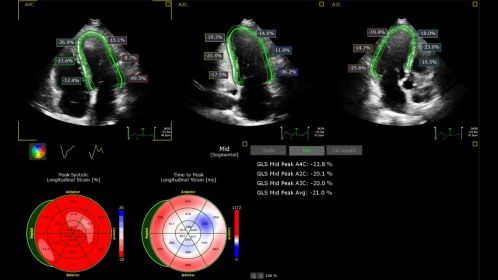 Ultrasound Workspace AutoStrain LV