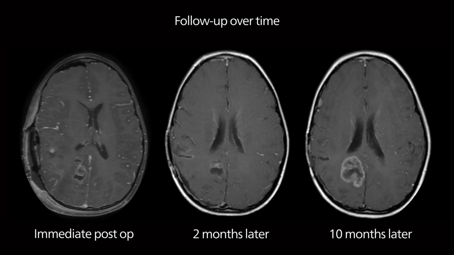 Post-op brain MRI over time 