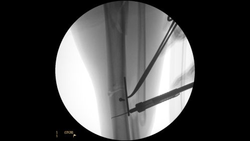 Clinical Image Philips BV Mobile C-arm Pulsera