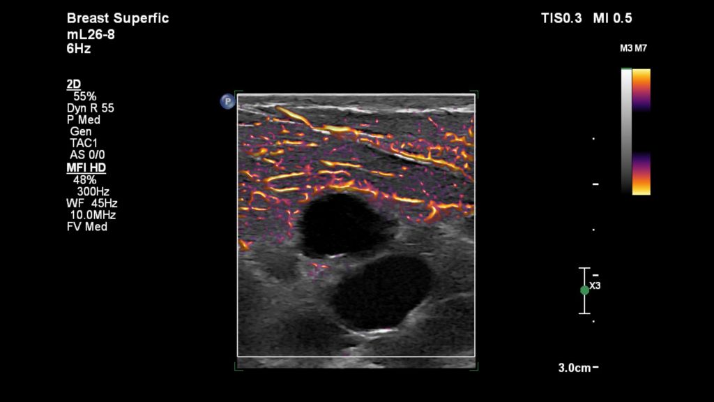 Breast superficial cysts
