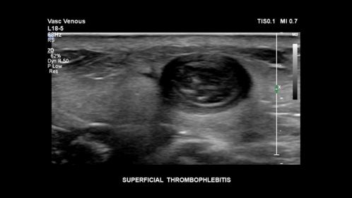 Superficial thrombophlebitis