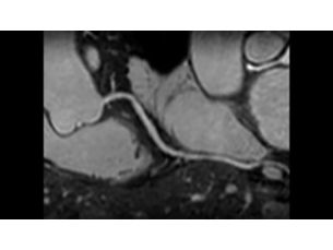 Coronary Acquisition Клиническое приложение для МР-исследований