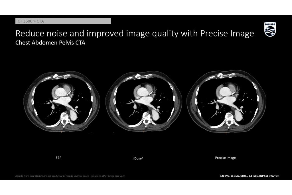 Chest Abd Pelvis Improved Image Quality AI Recon Precise