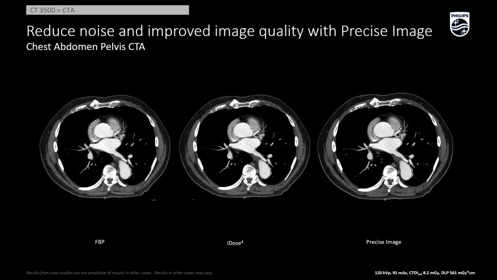 Chest Abd Pelvis Improved Image Quality AI Recon Precise
