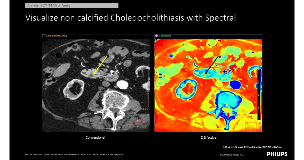 CT Spectral 7500 Body - Visualize non calcified Choledocholithiasis with Spectral