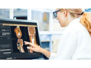 Pinnacle³ Assess, re-plan, and estimate accumulated dose distribution from multiple radiation treatment plans.