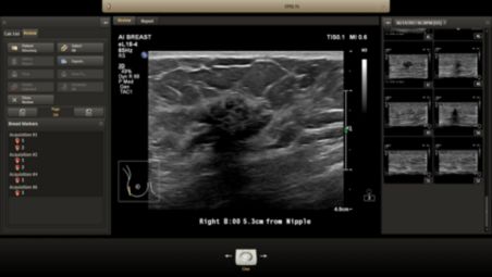 Anatomically Intelligent ultrasound - machine intelligence for faster more reproducible analysis