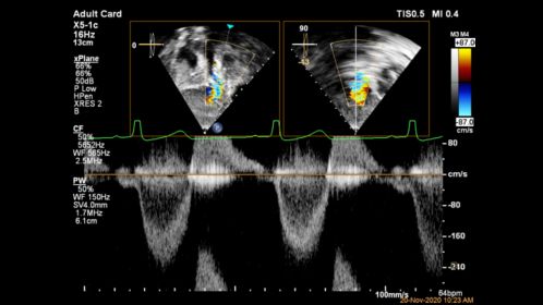 EPIQ CVx X5-1c xPlane Doppler