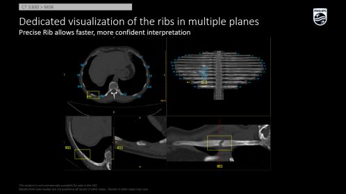 CT 5300 Precise Rib