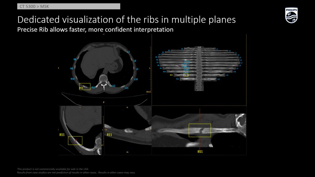 CT 5300 Precise Rib