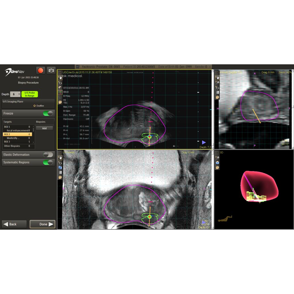 Philips - UroNav Bringing the power of MRI to Urology