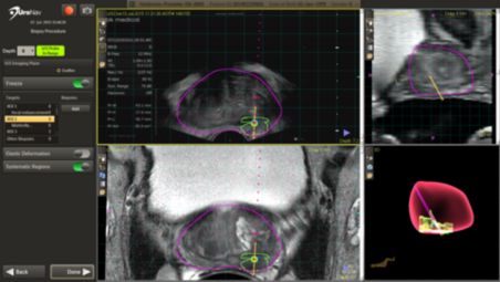 Fuse pre-biopsy MR and ultrasound images for a targeted biopsy