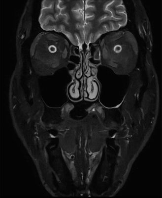 SmartSpeed Precise sinus clinical image