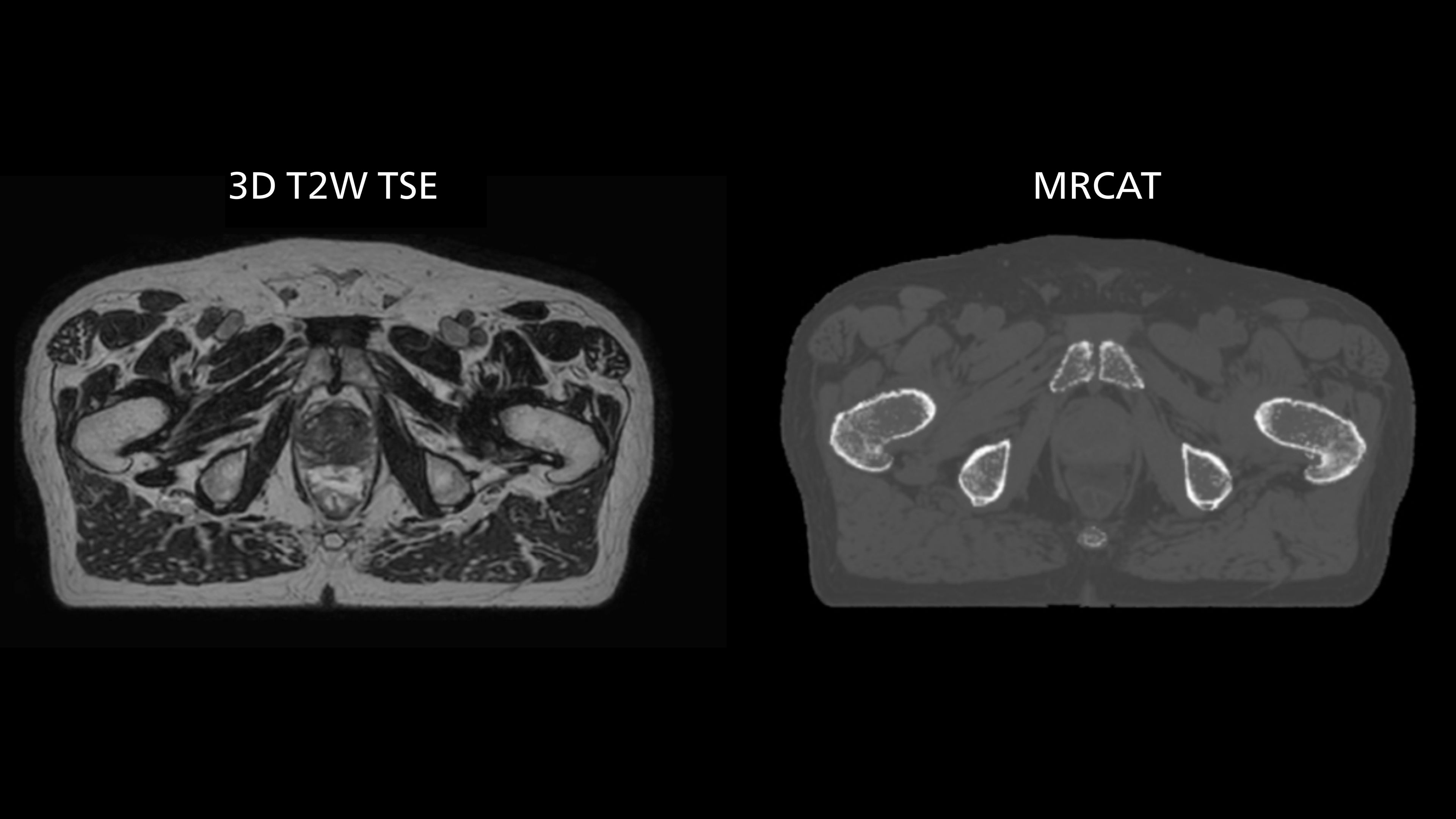 Transversal 3D T2W TSE and on-console generated MRCAT