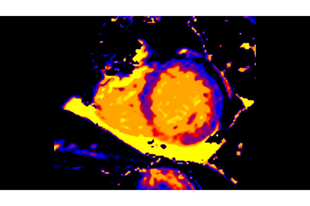 CardiacQuant - T1 map