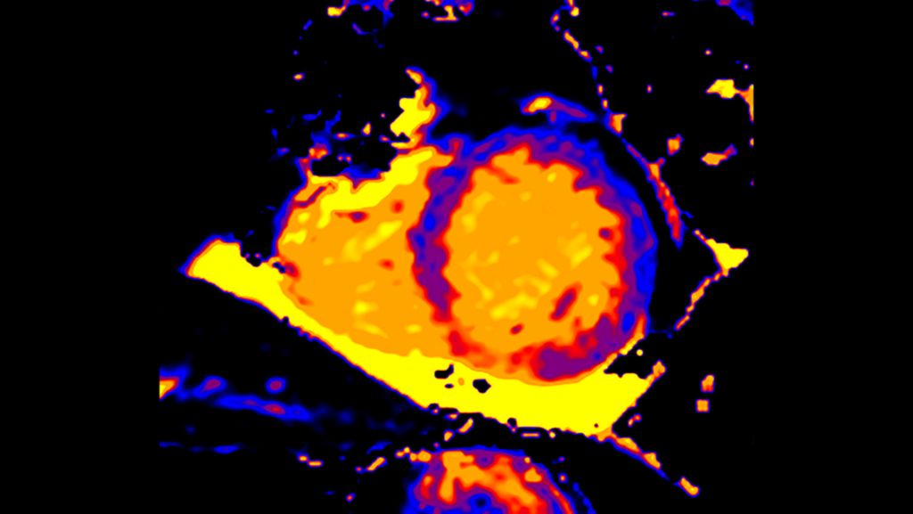 CardiacQuant - T1 map