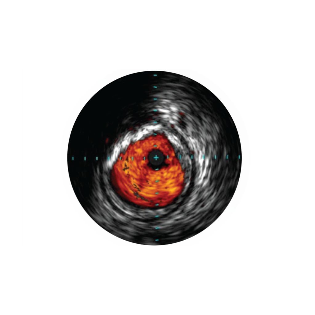 IVUS helps disease assessment