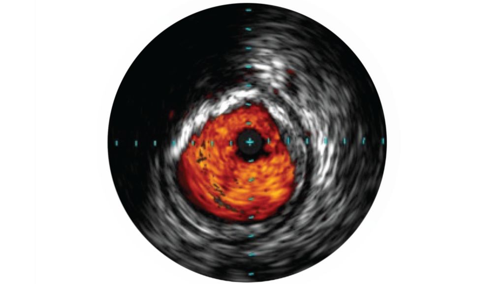 IVUS helps disease assessment