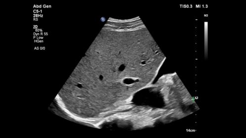 C5-1 Abdomen