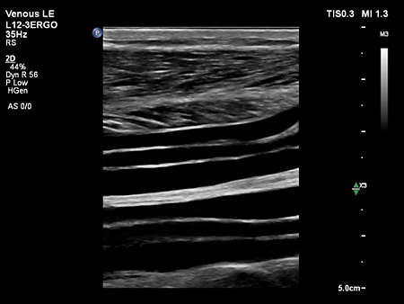 L12-3ERGO Lower Limb Veins