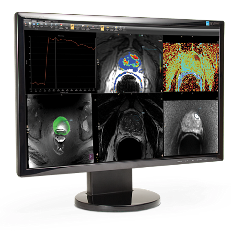 DynaCAD Prostate Visualización avanzada para el análisis de IRM de la próstata