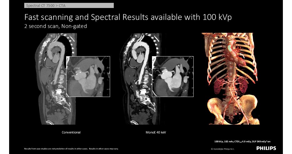 CT Spectral 7500 CTA -  Fast scanning and Spectral Results available with 100 kVp