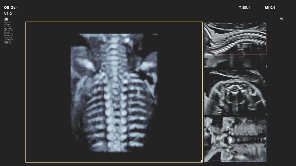 Expanded view of the fetal spine using the V9-2 transducer and TrueVue