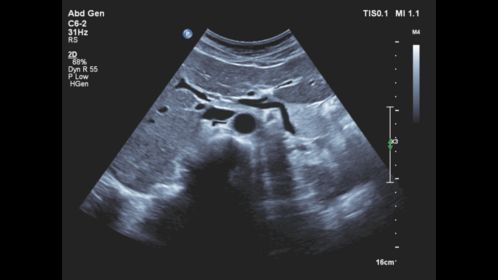 Affiniti 30 ultrasound clinical image abdominal